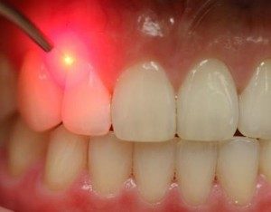 Gums Receiving LANAP® Laser Treatment For Gum Disease
