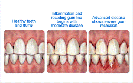 Progression Of Gum Disease - Brevard, NC And Hendersonville, NC