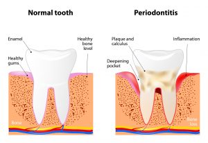 Gum Disease patient