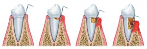 Periodontal Maintenance To Treat Gum Disease