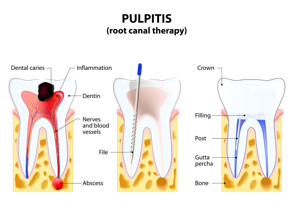Root Canal Treatment For Toothaches - Kyle, TX