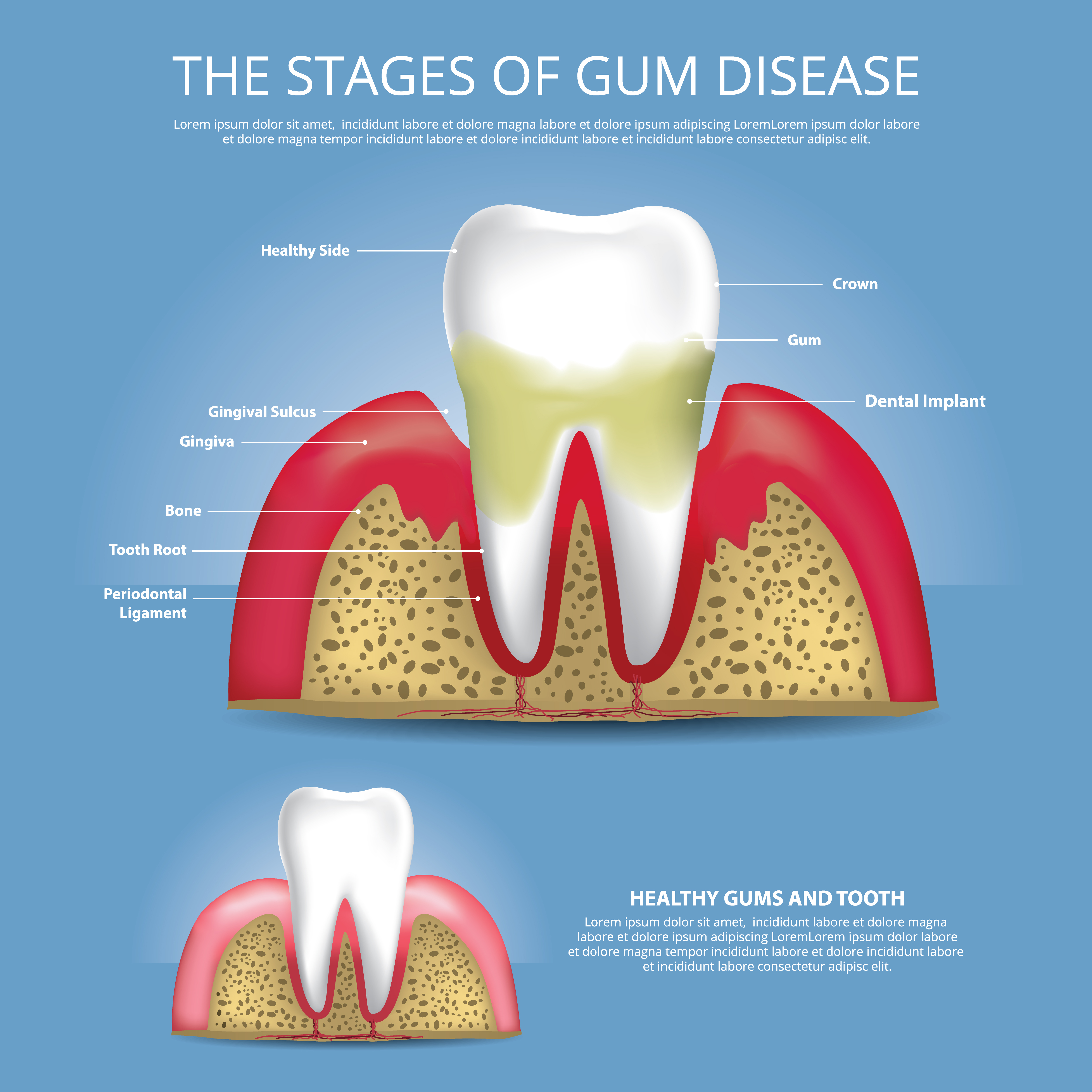 artists' rendering of the stages of gum disease