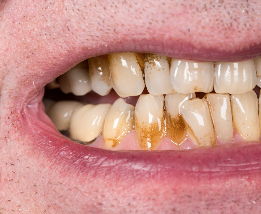 Permanent Gum Recession Treatment Medford & Moorestown, NJ