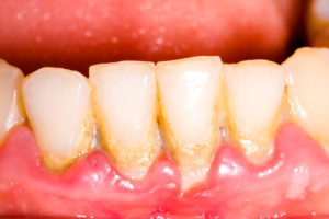 Lower arch of teeth showing signs of gingivitis
