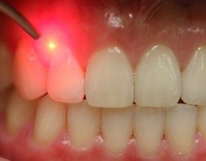 Laser dentistry for gum disease