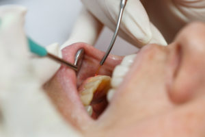 Closeup of woman undergoing soft and hard tissue laser dentistry