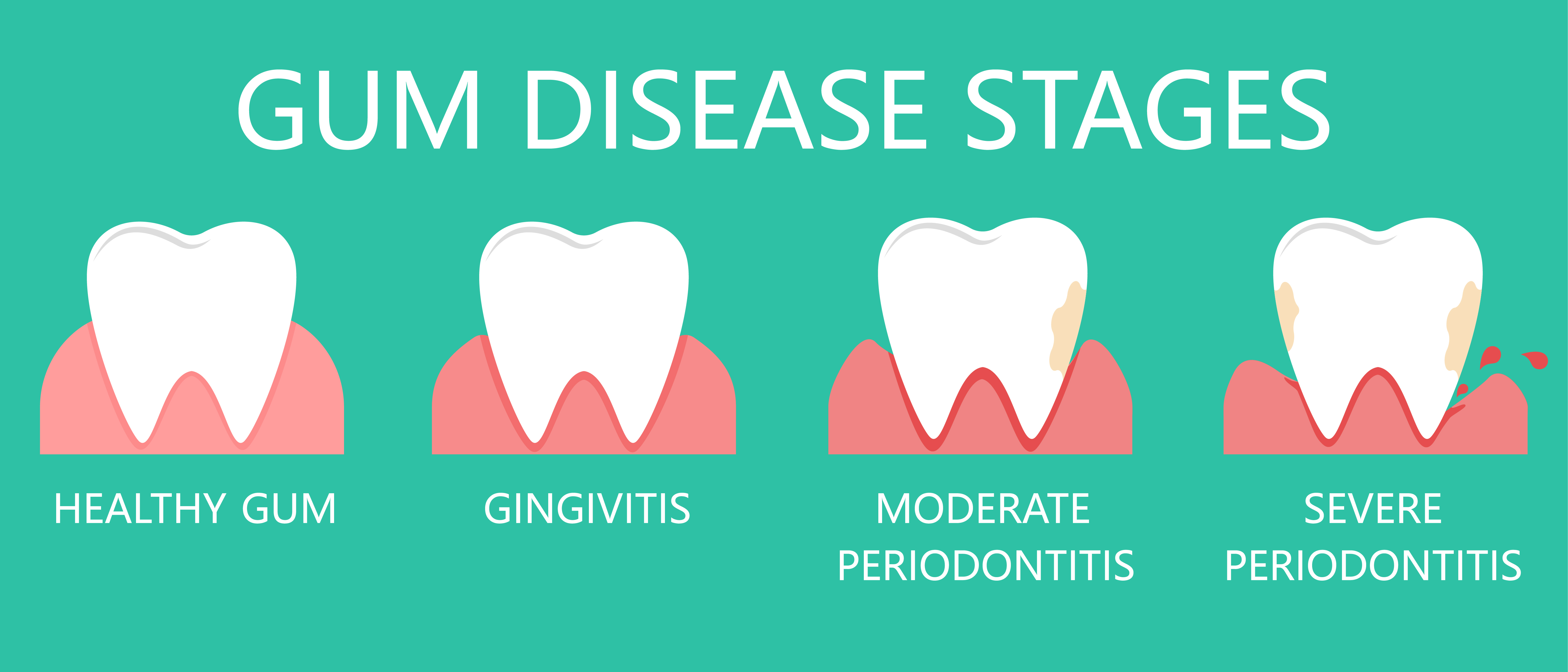Gum Disease Ann Arbor, MI Periodontist