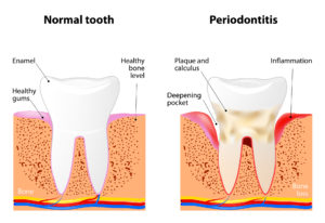 gum disease stages